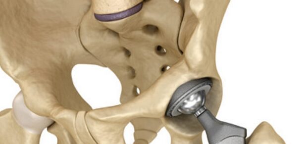 Fókuszban az ortopédiai műtétek