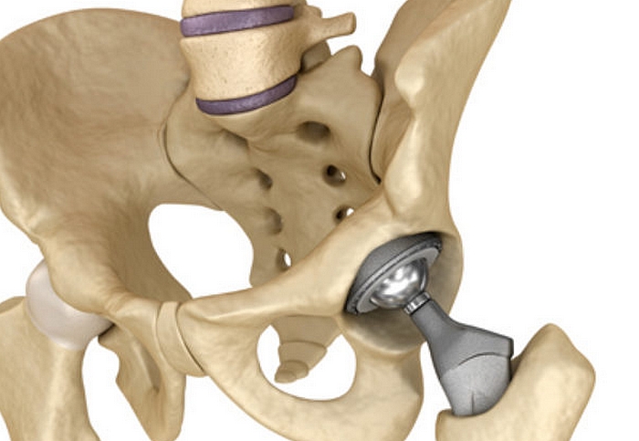 Fókuszban az ortopédiai műtétek
